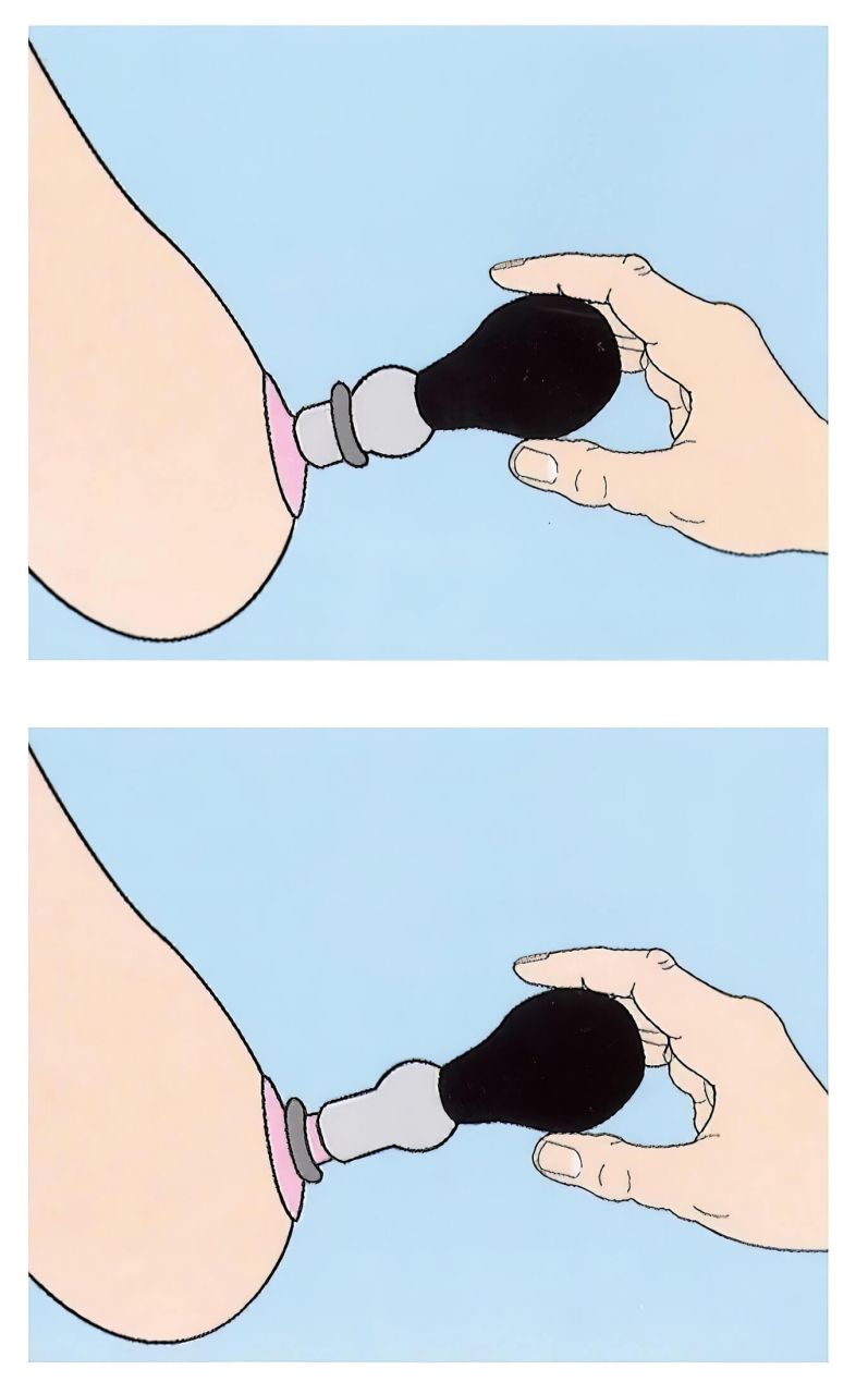 Mellbimbó pumpa szett (2db)